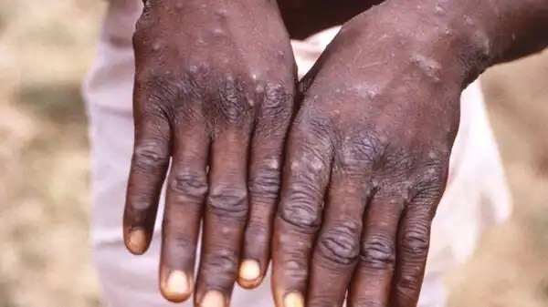 A suspected case of monkeypox was reported in Jamnagar's GG Hospital