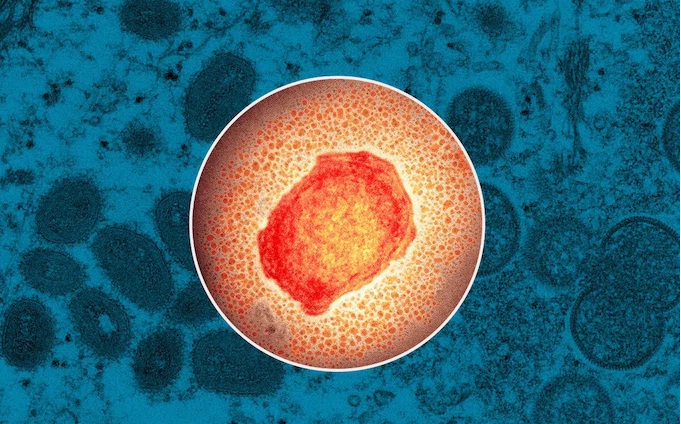 A suspected case of monkeypox was reported in Jamnagar's GG Hospital