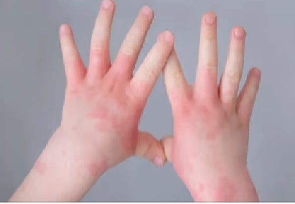 Cases of Tomato Flu are increasing in the country! The central government issued an advisory