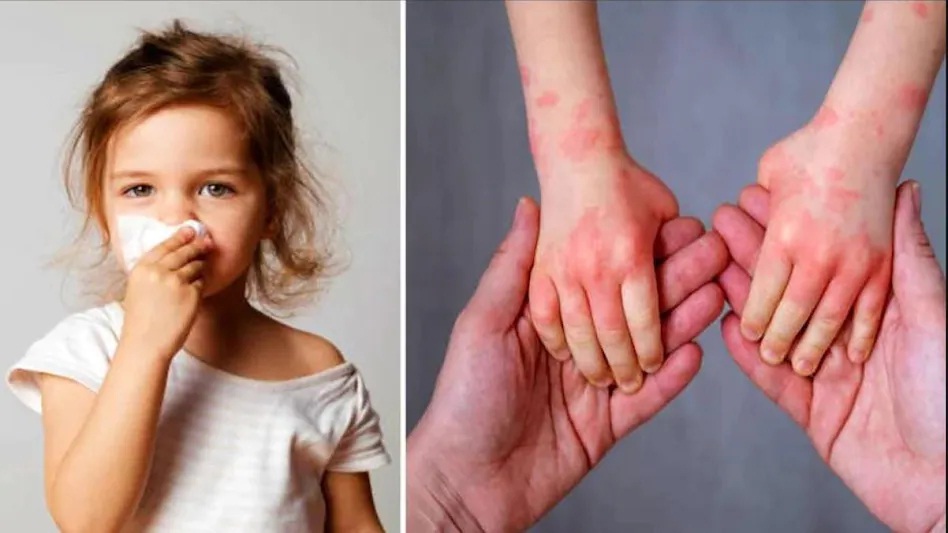 Cases of Tomato Flu are increasing in the country! The central government issued an advisory