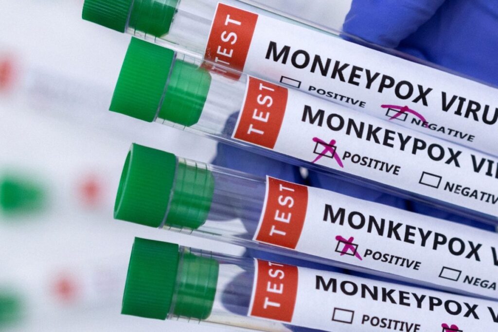 In Italy, a person got HIV, Corona and monkeypox together! Even the doctors were puzzled