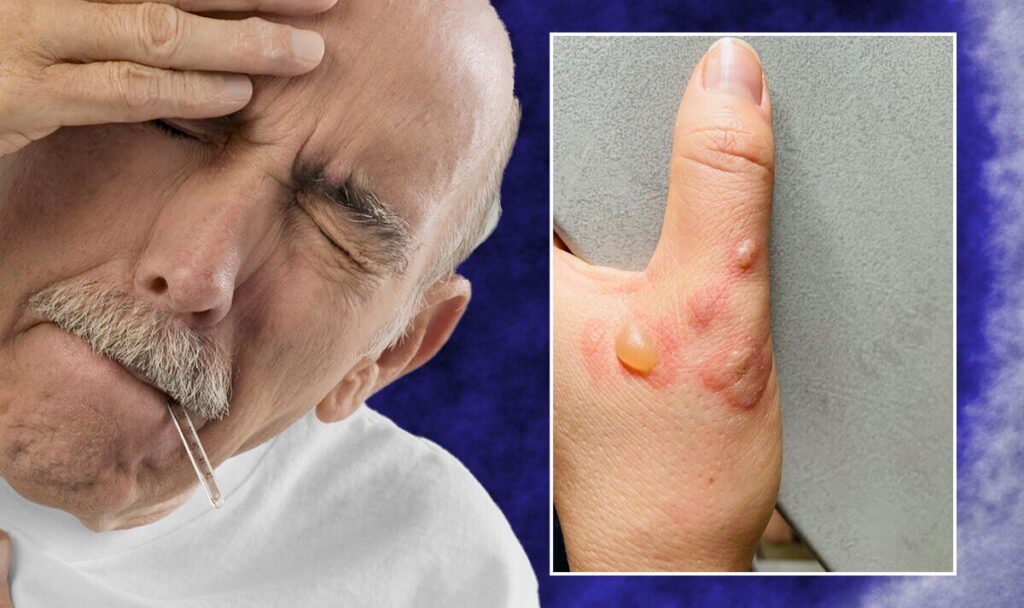 new symptoms of monkeypox