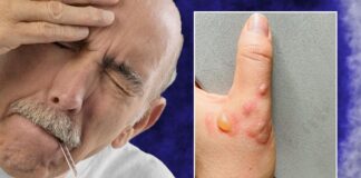 મંકિપોક્સના નવા 3 લક્ષણો આવ્યાં સામે જાણો તેના વિષે new symptoms of monkeypox