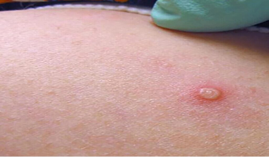 A suspected case of monkeypox was reported in Jamnagar's GG Hospital