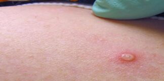 જામનગરની જીજી હોસ્પીટલમાં મંકીપોક્ષનો શંકાસ્પદ કેસ નોંધાયો A suspected case of monkeypox was reported in Jamnagar's GG Hospital