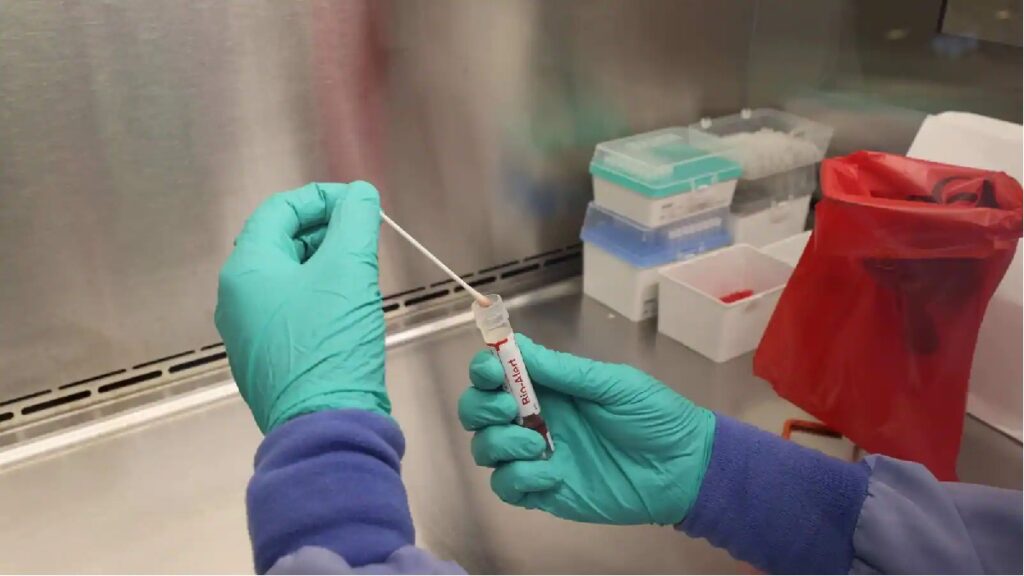 In Italy, a person got HIV, Corona and monkeypox together! Even the doctors were puzzled